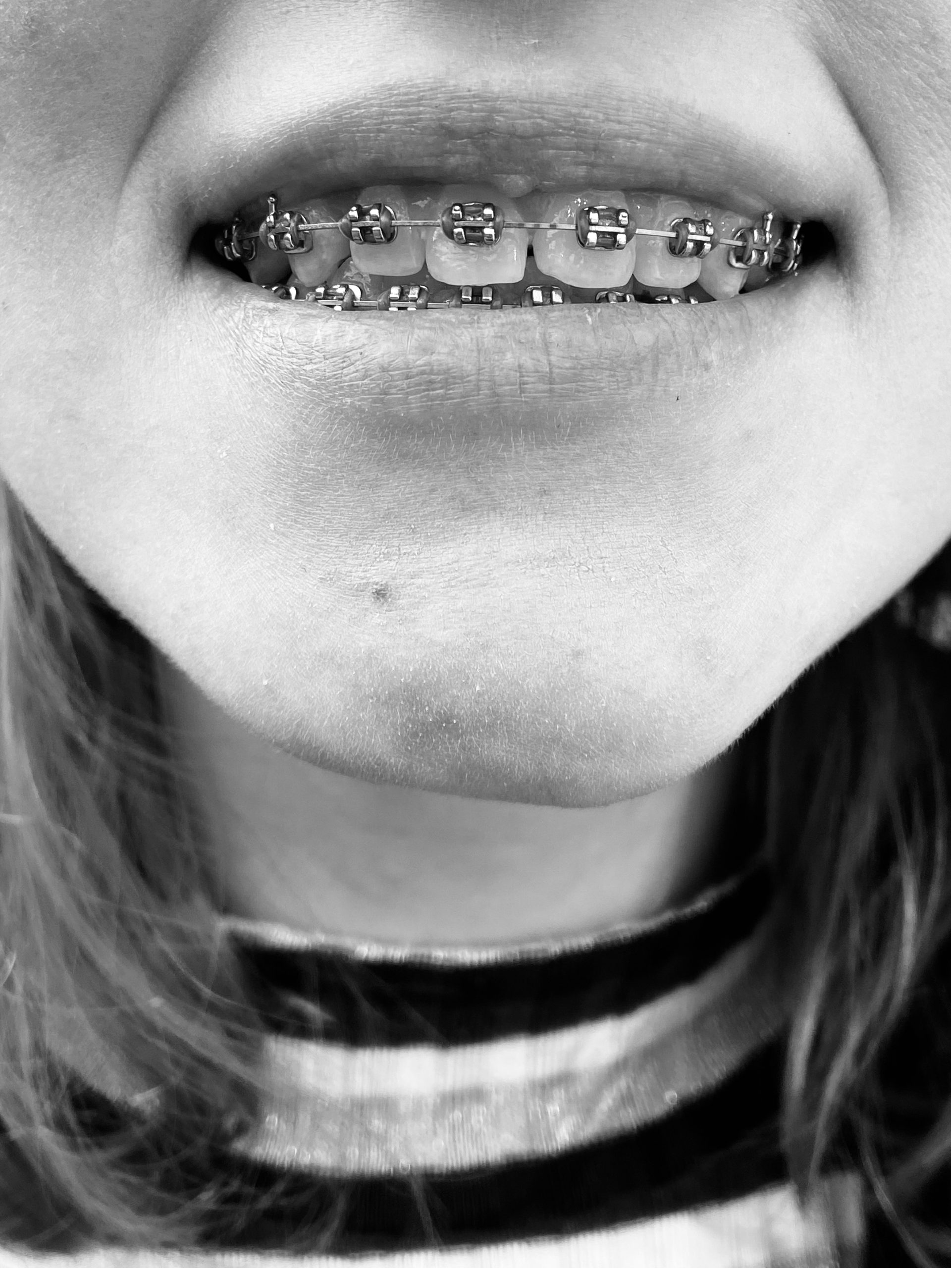 The Role of Braces in Orthodontic Treatment