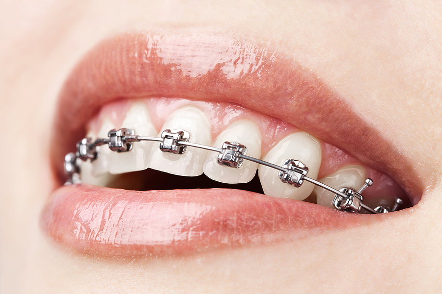 Achieve a Beautiful Smile with Braces in Mesa, AZ: Your Guide to Orthodontic Treatment