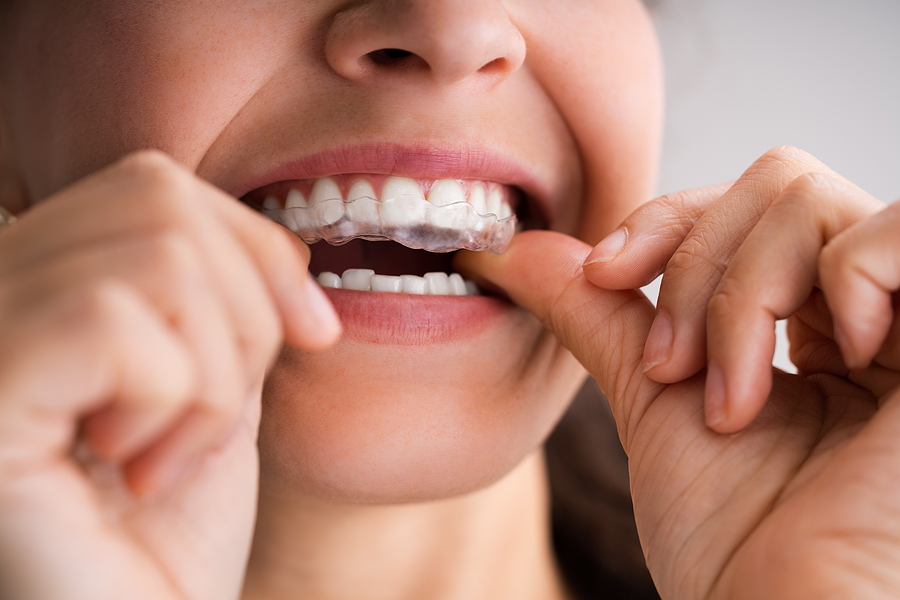 Achieving a Straighter Smile with Clear Aligner Treatment in Mesa, AZ