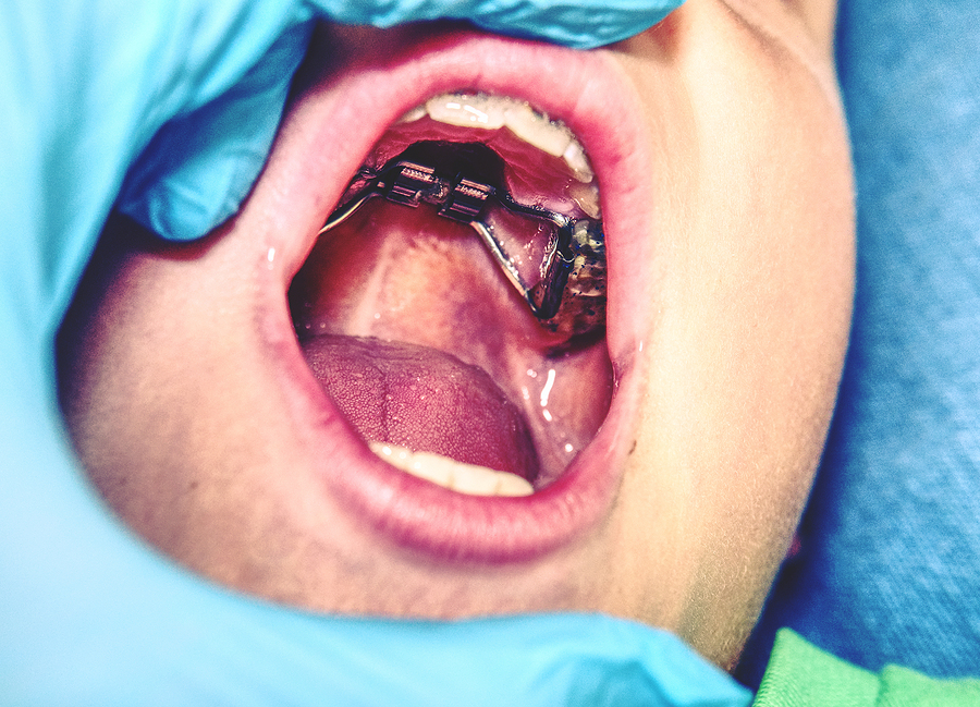 Understanding Palatal Expanders: A Guide to Orthodontic Treatment
